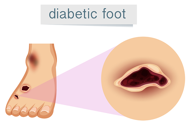 A human foot with diabetic  illustration