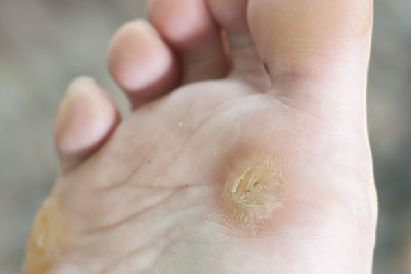 Callus removal