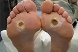 Diabetic : High risk foot care