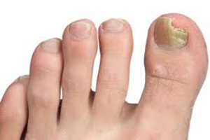 Fungal Nail
