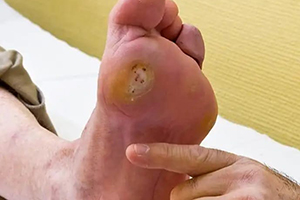 Verruca treatment & advice