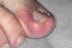 ingrown-nail